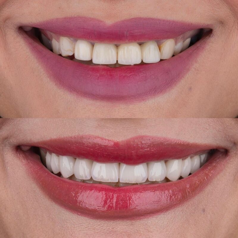 Laminate Veneer woman's teeth before after