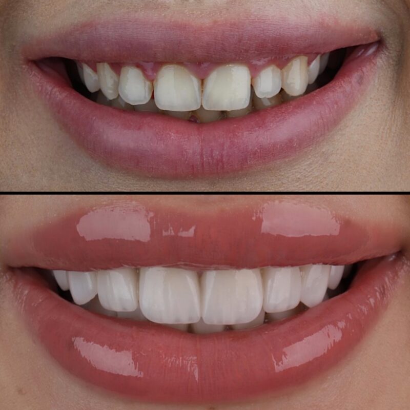 Gum Surgery teeth before after