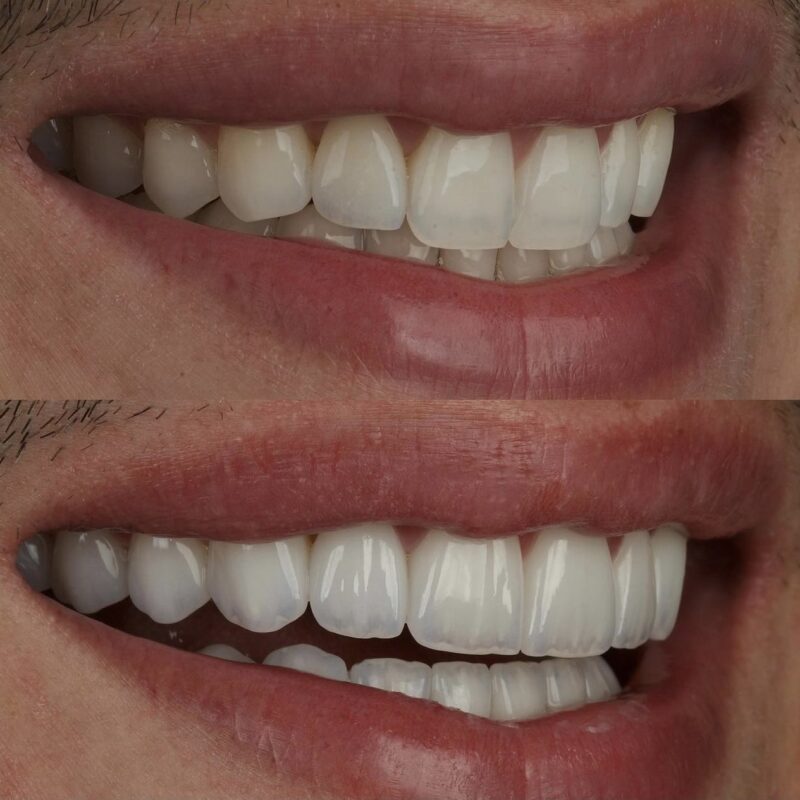 Smile Design teeth before after