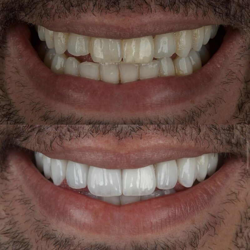 Periodontics teeth before after