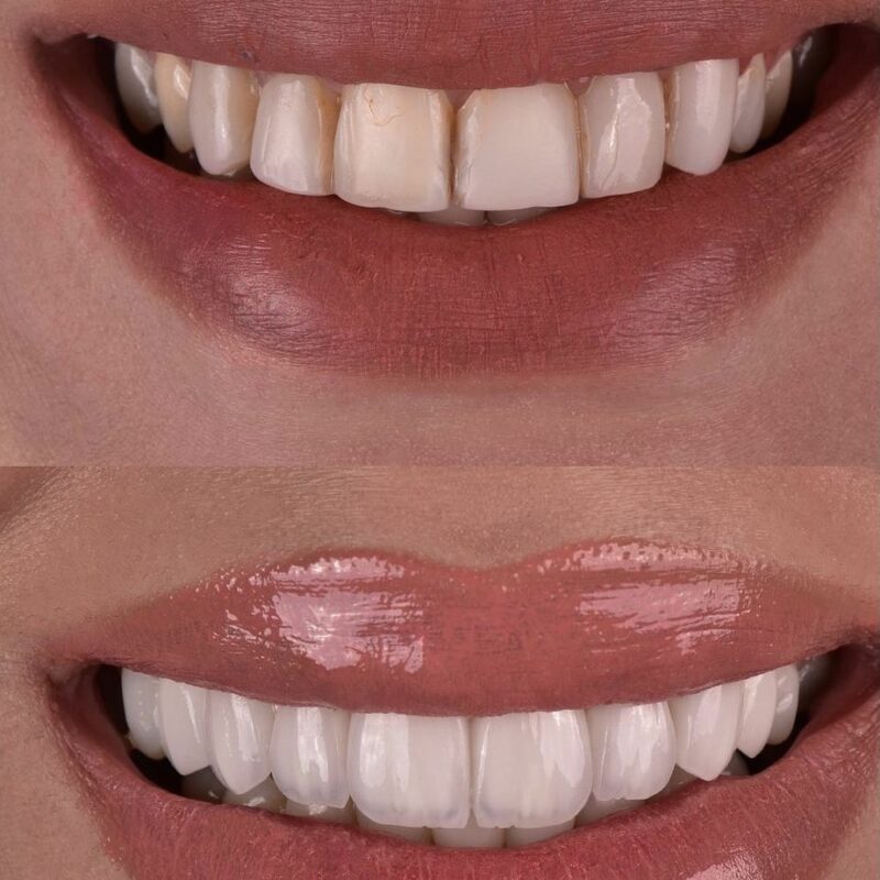 Smile Design woman's teeth before after