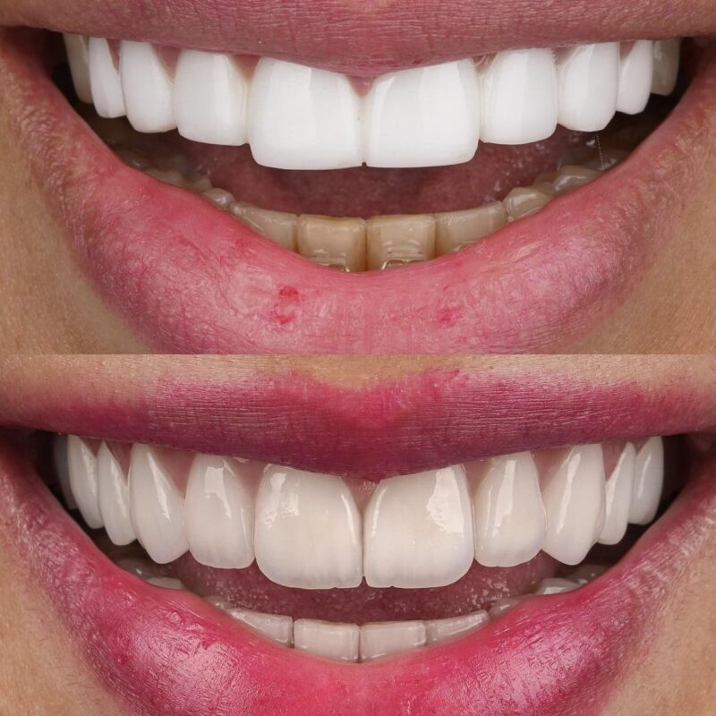 Periodontics teeth before after
