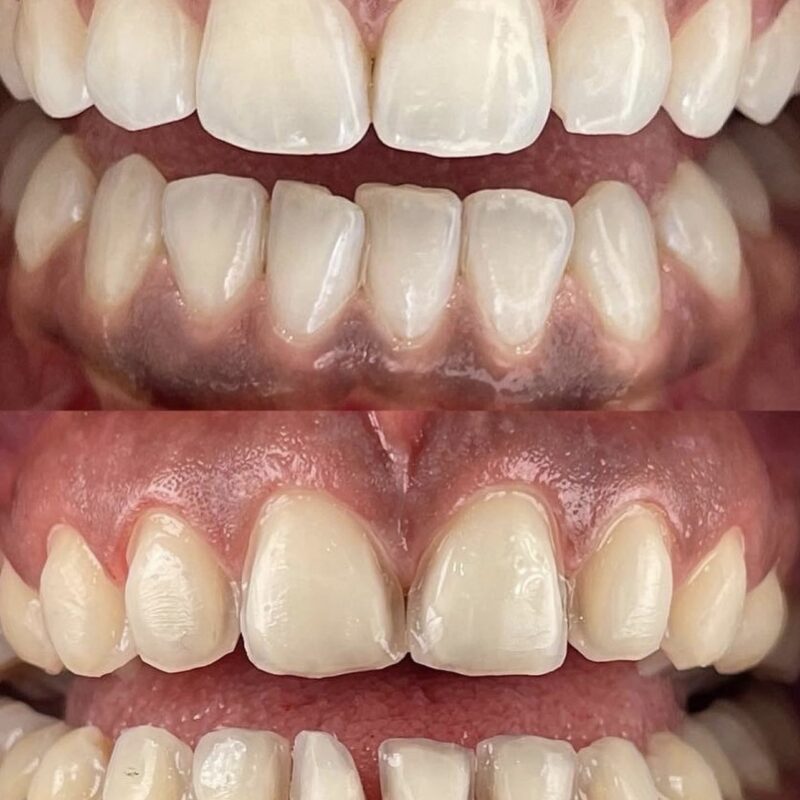 teeth whiting before after